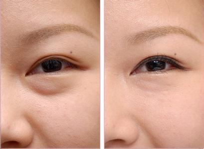 眼部吸脂手术效果好吗