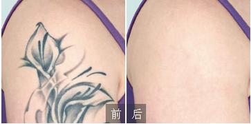 激光洗纹身术后要怎么护理