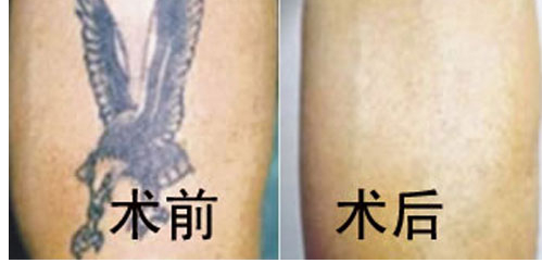 激光洗纹身效果怎么样