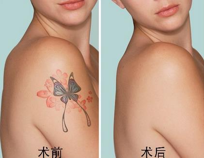 激光洗纹身安全又彻底吗