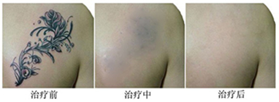 如何去纹身比较好