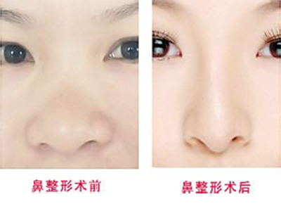 假体隆鼻手术术后要怎么护理