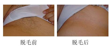 光子永久脱毛大概要多少钱