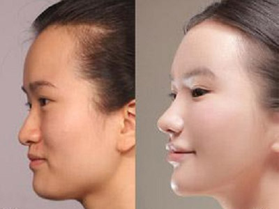 自体脂肪隆鼻手术是什么