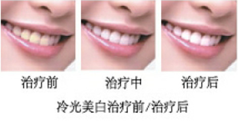 冷光美白牙齿的价格