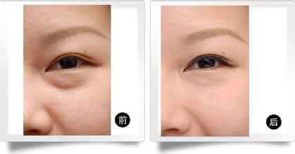 上海做眼部吸脂效果怎样
