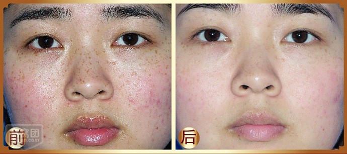 为什么女性容易长雀斑