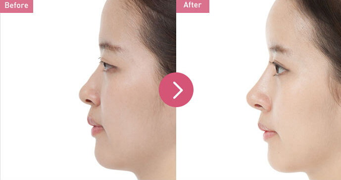 自体脂肪丰下巴好不好呢