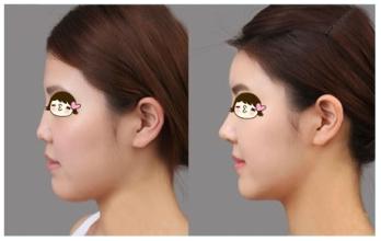 做下巴整形手术会不会有坏处