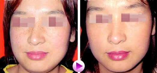 上海雀斑治疗医院是哪家