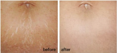 上海哪家整形医院祛妊娠纹好-上海艺星整形医院