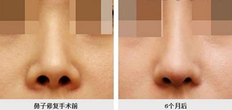 假体隆鼻失败修复怎样做_隆鼻修复整形要注意什么