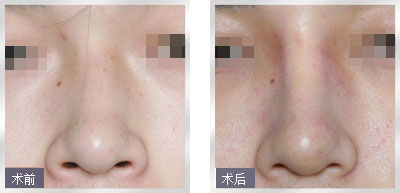 隆鼻修复手术后要怎么护理