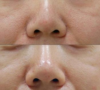 光子嫩肤治疗毛孔粗大效果怎么样