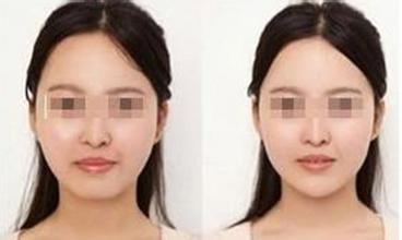 丰下巴有哪些安全隐患_垫下巴有什么坏处