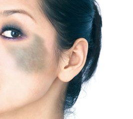 太田痣的并发症有哪些