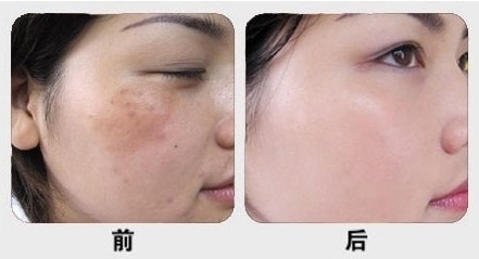 上海激光祛除晒斑有什么优势