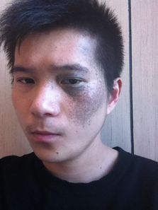 上海治疗太田痣的方法有哪些