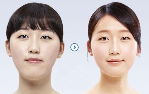 下巴整形需要多久恢复