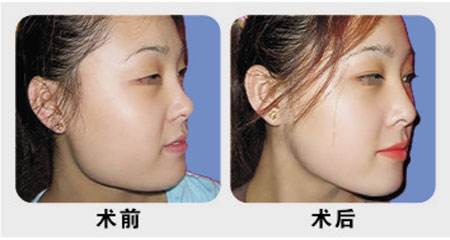 下巴整形手术要注意什么
