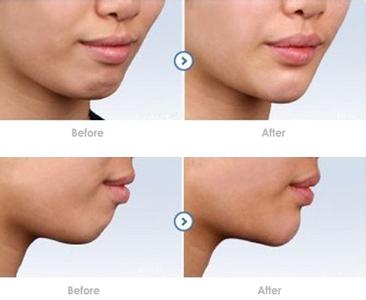 下巴整形术后有没有后遗症呢