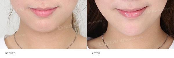 下巴整形术后有没有后遗症呢