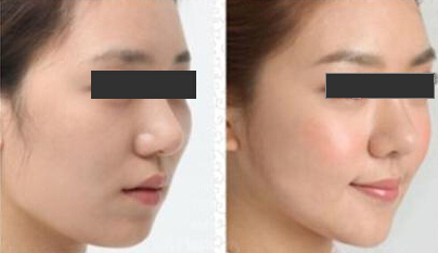 下巴整形方法是什么