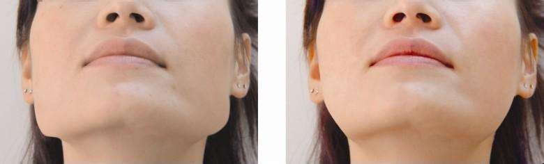 上海艺星下巴整形有风险吗