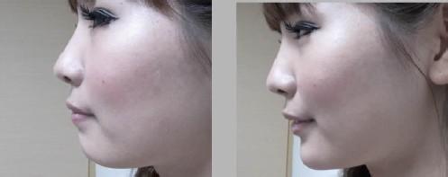 上海艺星下巴整形有风险吗