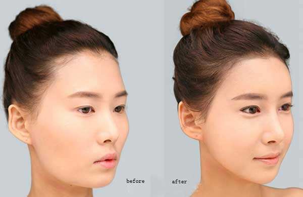 垫下巴有风险吗