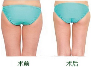 怎么瘦臀部好