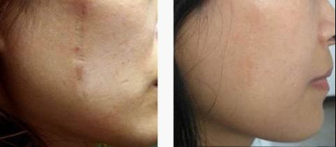 疤痕有副作用吗