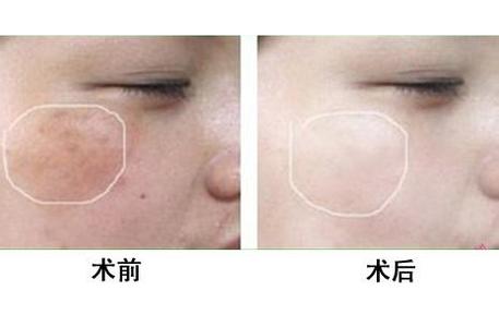 治胎记要多少钱