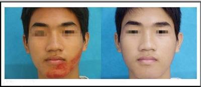 激光祛胎记有没有副作用