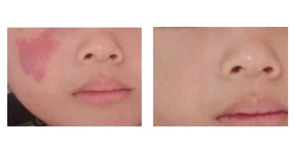 哪些人容易长胎记