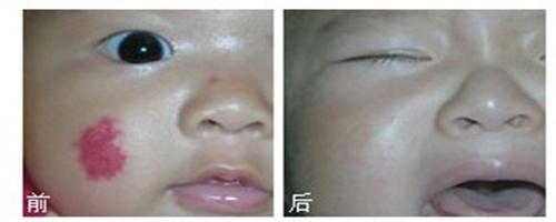 小孩身上的红胎记可以去掉吗