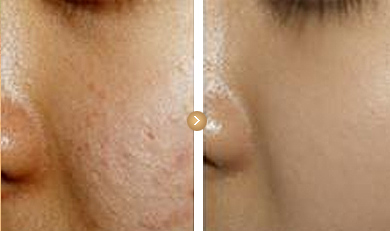 激光祛痘多少钱