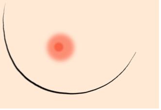 上海乳晕整形方法有哪些