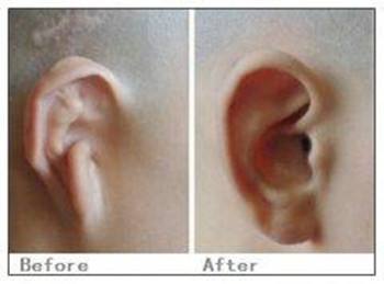 治疗副耳什么时候效果推荐