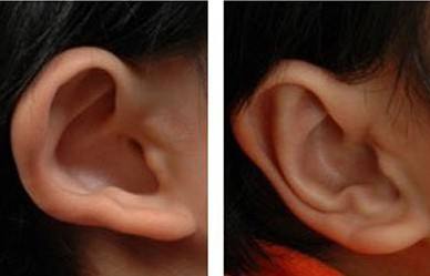 上海招风耳手术的方法及过程
