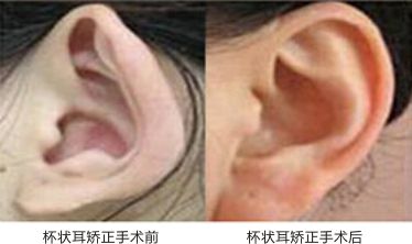 上海杯状耳矫正术需要多少钱