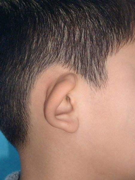 杯状耳畸形的表现及治疗