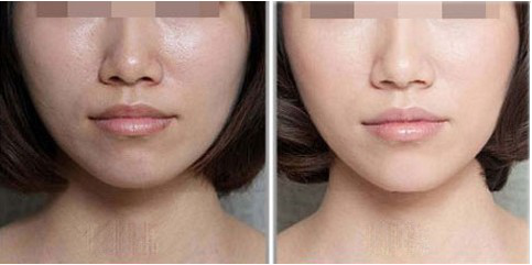 彩光嫩肤治疗毛孔粗大有什么优点