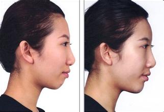 水光能不能除皱