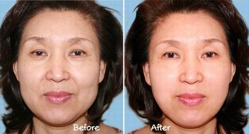 水光能改善哪些皮肤问题