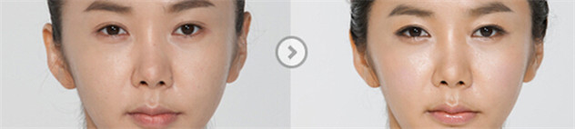 水光的优点有哪些