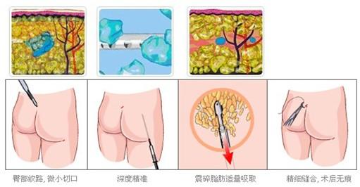 臀部吸脂手术过程