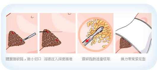 上海艺星做腹部吸脂效果