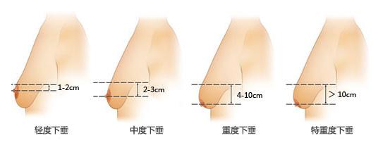 乳房下垂程度