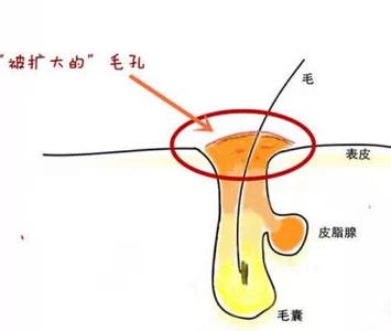 毛孔粗大